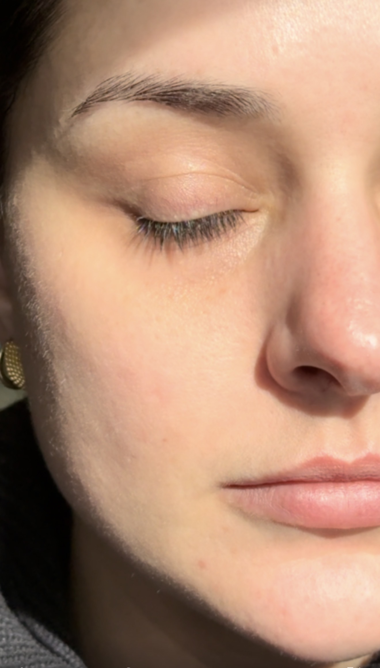 Close up of a cheek and jawline after at home dermaplaning