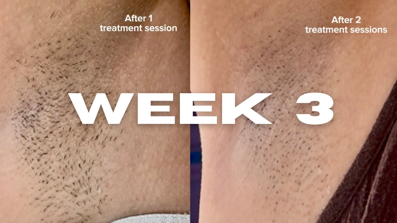 Underarm IPL progress at week three: after one Nood Flasher Pro session on the left, after two sessions on the right